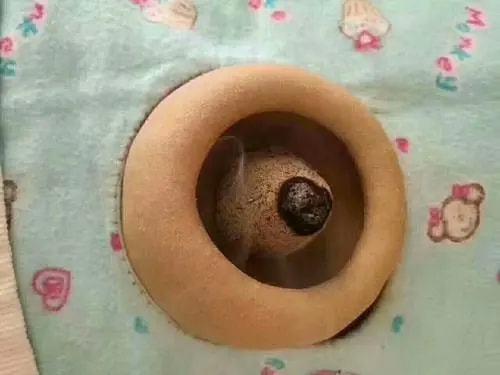 脐灸操作视频